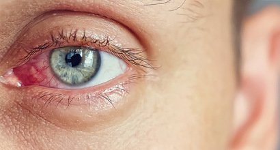ophthalmologische_manifestationen_von_dengue